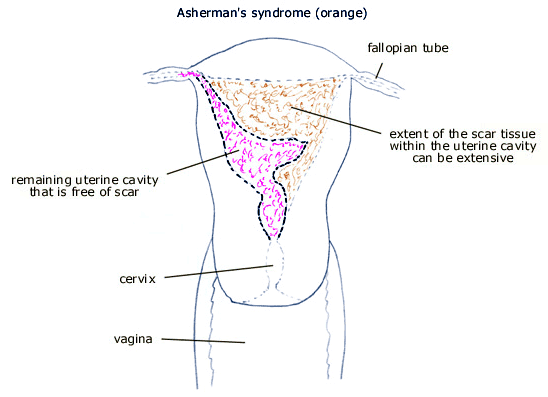 asherman's syndrome