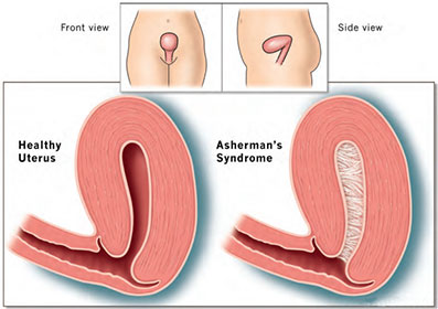 how is asherman's syndrome diagnosed