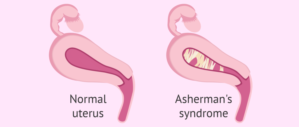 Asherman's syndrome