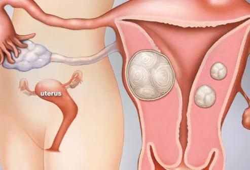 types of uterine problems