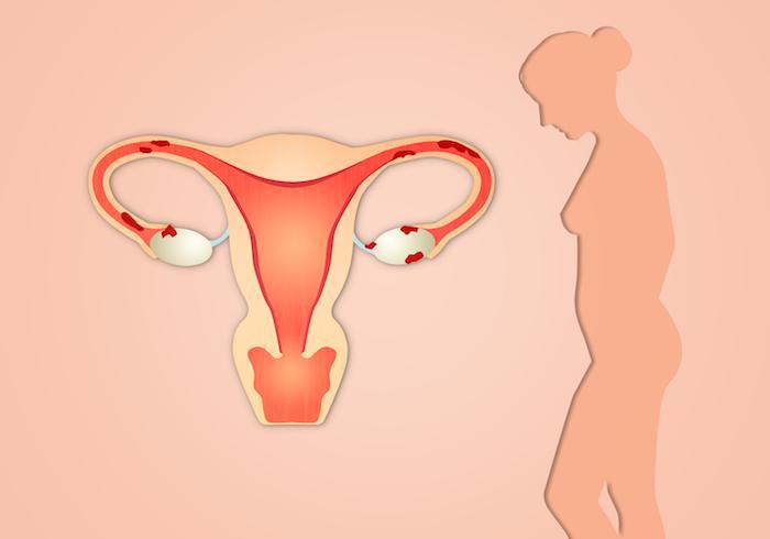 what are uterine problems?