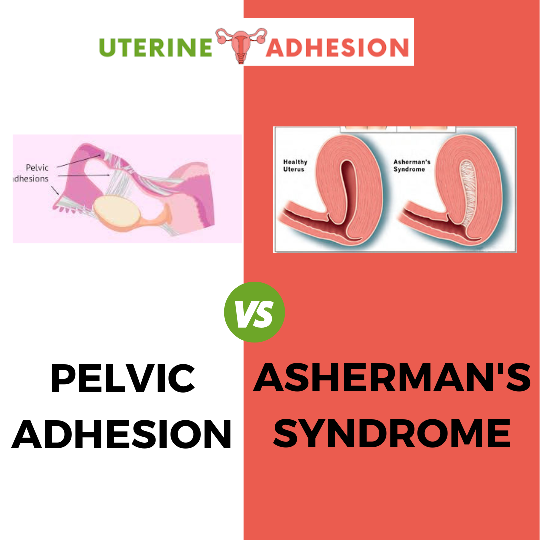 Pelvic Adhesions Vs Asherman’s Syndrome