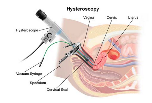 hysteroscopic-myomectomy that may lead to Asherman's syndrome
