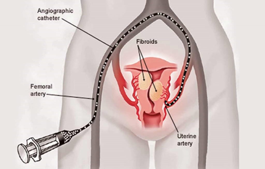 uterine-fibroid-embolization